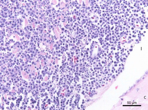 Figure 3. Histopathological section (HE) of the female's iris (I) showing a diffuse infiltration with round cells with a large central nucleus and a large amount of apoptotic cell bodies (C: Cornea).