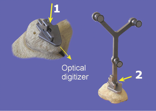 Figure 1. The patellar marker array was attached in two steps. First, the base was attached with a bone screw to the anterior surface of the patella, mediolaterally, facing towards the optical digitizer. Second, the marker array was screwed onto the base in one of three positions, suiting an upright or everted patella, with either a laterally or medially placed optical digitizer and a medial or lateral incision. [Color version available online.]