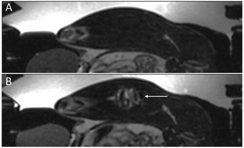 Figure 9. Pre- and post-FUS T2-weighted images. Image taken prior (A) and post (B) treatment. Arrow demonstrates areas of significant hyperintensity associated with edema. Total post-treatment hyperintense volumes were 936, 2376, and 1402-mm3 for Rabbits 1–3, respectively. Volume was not calculated for Rabbit 4.