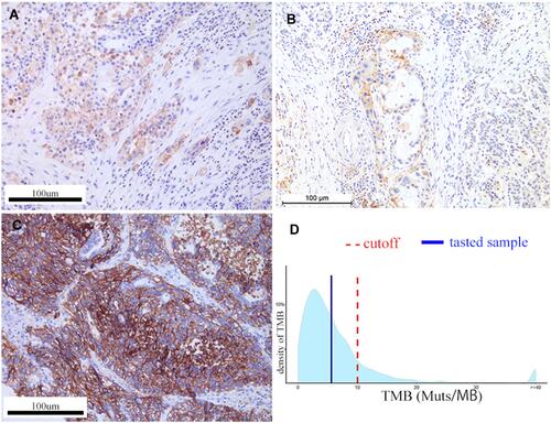 Figure 4 (A and B) Targeted-gene sequencing showed PD-L1 expression in pancreatic tumor. (C) Isotype-matched monoclonal antibodies were used for control staining and to confirm that the specificity of primary antibody binding. (D) Targeted-gene sequencing showed the quantity of tumor mutation burden (TMB).