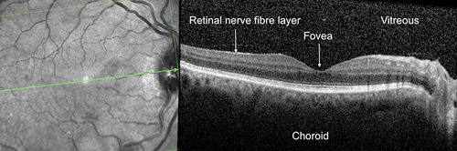 Figure 3 Optical coherence tomography of the right eye which demonstrates no associated macular edema, as shown by normal foveal thickness.