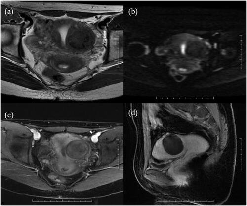 Figure 4. A 25-year-old patient with a uterine fibroid in the left wall of the uterus. Before HIFU, her uterine fibroids showed low signal intensity on T2WI (a) and DWI (b) and were slightly enhanced on CE-MRI (c); all their values were 0. The values of wavelet_HHH_firstorder_Skewness and wavelet_HHL_glszm_sizezonenonuniformity were 0.16 and 3.00, respectively. The ablation area was not enhanced on CE-MRI after HIFU (d). The predicted and actual NPVR values were 94% and 98%, respectively.