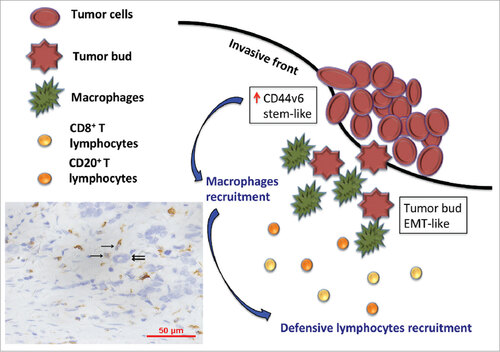 Figure 3. The model shows a hypothesis that tumor cells with stem-like phenotypes recruitment TAMs (brown, single sword) to the invasive front of tumor lesion and surround around tumor buds (double swords). Subsequently, TAMs induce immune response, especially CD8+T and CD20+ B lymphocytes, to eliminate these highly invasive tumor buds.