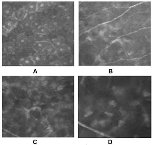 Figure 2 Vernal keratoconjunctivitis (VKC) corneal alterations as observed with confocal microscopy. (A) Larger and hyperreflective epithelial cells; (B) tortuous superficial nervous plexus; and (C–D) higher concentration of inflammatory cells and activated keratocytes.