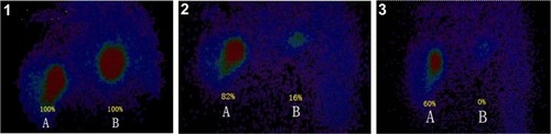 Figure 6 Comparison of the retention rate of 99Tcm-Ara-C with and without oxidant after intratumoral injection at different locations in the same liver.