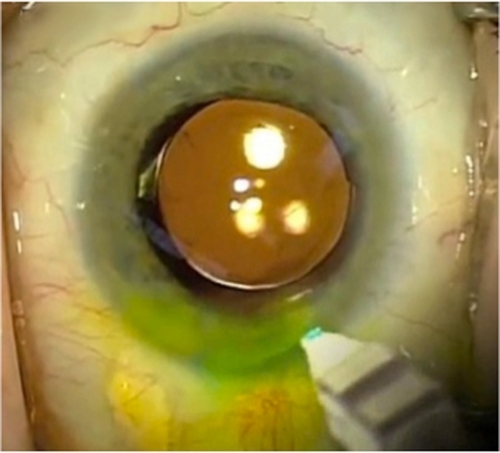 Figure 1 Representative photograph of the hydrogel ocular bandage being applied on the ocular surface following cataract surgery. Note that the yellow coloring is from the fluorescein staining of a Seidel test. Photo courtesy of Dr Samuel Masket.