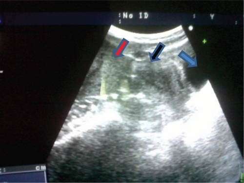 Figure 1 A transabdominal ultrasound scan showing the mass (red arrow) and the uterus (black arrow), bladder (blue arrow).