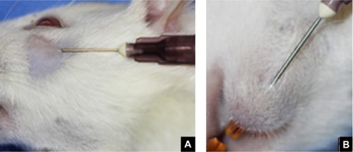 Figure 1 Techniques for subcutaneous and submucosal PMMA injection.