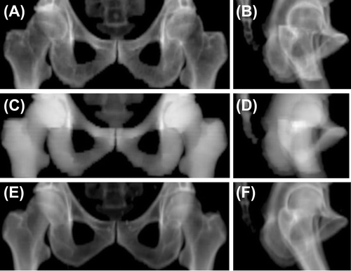 Figure 2. Example reference DRRs reconstructed from different 3D image series; the heterogeneous pseudo-DRRs (A) and (B), the bulk pseudo-DRRs (C) and (D), and the CT-DRRs (E) and (F) (PA and RL, respectively).