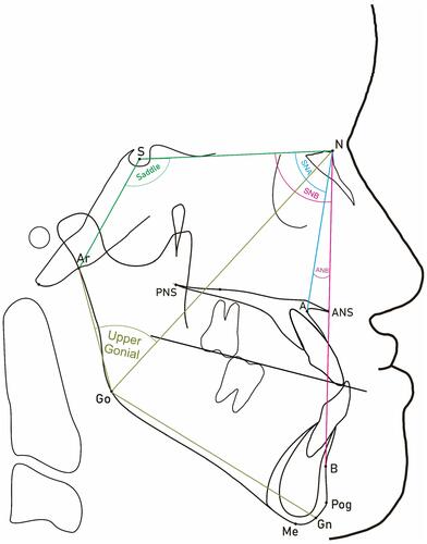 Figure 2 Anatomical lines and angles used in this study to determine sagittal dysplasia and growth of the nasomaxillary and mandibular complexes in the horizontal direction.