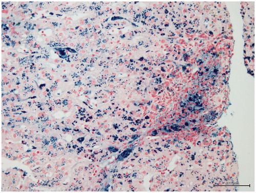 Figure 2. There is marked iron deposition (Grade 3) that is most prominent in portal macrophages and zone 1 hepatocytes and Kupffer cells (Perls stain ×200).