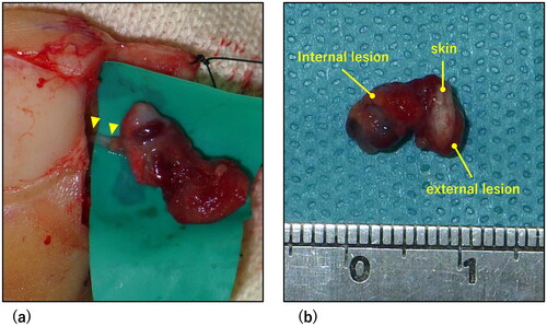 Figure 4. Intraoperative findings. (a) Intraoperative Photograph. A terminal branch of the digital artery flowed into the deep part of the lesion (arrowhead). (b) Photograph of the resected lesion. The lesion was hourglass-shaped, separated by the skin.