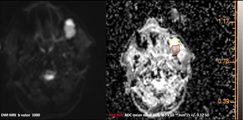 Figure 3 DW-MRI findings of our representative case of a 54-year-old man with MT (yellow circle) in left buccal space. DWI sequences at 1000 s/mm2 showed a non-homogeneous hyperintensity in diffusion weighted sequences with an area of restricted diffusion and low apparent diffusion coefficient (ADC) mean value of 0.963 × 10−3 mm2/s in the corresponding map, Red region of interest (ROI).