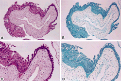 Figure 3. Complete mole is seen at 10 × lens (A and B) and 20 × lens (C and D) hematoxylin and eosin stain (A and C). There is no p57 staining (B and D) in the cytotrophoblast or in the intermediate trophoblast.