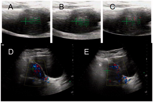 Figure 4. HIFU PRO2008 ablation therapy on placenta accreta with marked vascularity. (A,B,C) showed HIFU ablation arrays, (A) 31st slice, (B) 32nd slice, (C) 33rd slice. (D) Doppler ultrasound before HIFU, (E) Doppler ultrasound after HIFU treatment at 31st slice showed blood flow reduction.