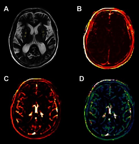 Figure 2 An example map in the BG (×1). (A) Axial FLAIR image of a 71-year-old man and ROIs; (B) Ktrans map; (C) AUC map; (D) Vp map.Abbreviations: BG, basal ganglia; FLAIR, fluid-attenuated inversion recovery; ROIs, regions of interest; Ktrans, BBB leakage rate; BBB, blood-brain barrier; AUC, area under the leakage curve; Vp, fractional blood plasma volume.