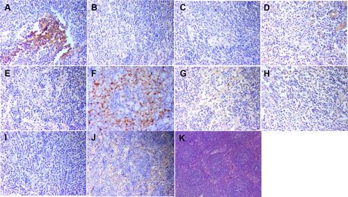 Figure 3 The immunostaining of right cervical lymph node for cytokines. (A) (b-FGF;×200), positive; (B) (IL-1β;×200), positive; (C) (IL-2;×200), positive; (D) (IL-6;×200), positive; (E) (IL-10,×200), positive; (F) (MUM-1×200), positive; (G) (PDGF×200), positive; (H) (TGF-β×200), positive; (I) (TNF-α×200), positive; (J) (VEGF×200), positive; (K) HE, ×40.