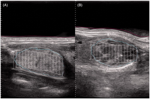 Figure 1. Exemplary ultrasound imaging of (A) a solid nodule and (B) a complex nodule during HIFU planning. The investigating physician drew the light blue line constituting the nodule and the red line constituting the skin. The white bars symbolise the planned treatment sites.