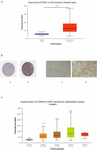 Figure 4. The expression of CDK4 in HCC tumor tissues and non-tumor tissue .(Figure 4 A) Transcriptional level of CDK4 expression was found to be in 371 HCC tissues compared with 50 normal tissues. Protein expression of CDK4 was significantly higher in HCC tissues(Figure 4b-b) compared with normal liver tissues(Figure 4b-a); and the Protein expression of CDK4 was also significantly higher in HCC tissues (Figure 4b-d) compared with paired paracancerous tissue tissues (Figure 4b-c) .(c) Transcriptional expression of CDK4 was significantly correlated with tumor grade, while patients in more advanced grade score expressed higher levels of CDK4 mRNA. The highest CDK4 mRNA expression was found in stage 3