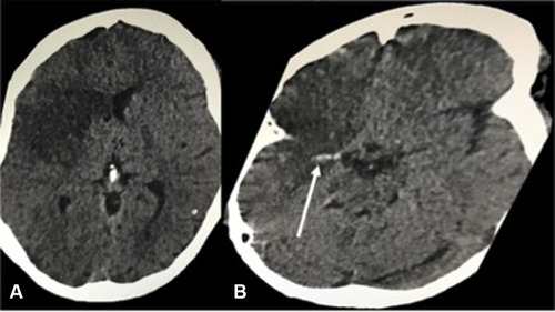 Figure 3 Unenhanced computed tomography of brain, (A) axial image at the level of anterior horns of the lateral ventricles demonstrating a large geographic area of hypodensity involving the right frontopareitotemporal cortex. (B) axial image at the level of circle of Wills demonstrating hyperdense middle cerebral artery sign (white arrow) of the M1 segment of the right middle cerebral artery.