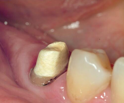 Figure 8 Intraoral photography after digital impression with Trios 3shape scanner.