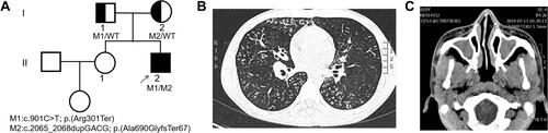 Figure 1 (A) Pedigree of patient’s family with inherited CCDC40 pathogenic variants. Black arrow, proband. Half-colored symbol, heterozygous CCDC40 variant carrier. Solid symbol, patient (affected). (B) Lung high-resolution computed tomography of the patient showed diffuse nodules among small airway and bronchiectasis in right middle lung and both lower lungs. (C) High-resolution computed tomography of the patient showed sinusitis.