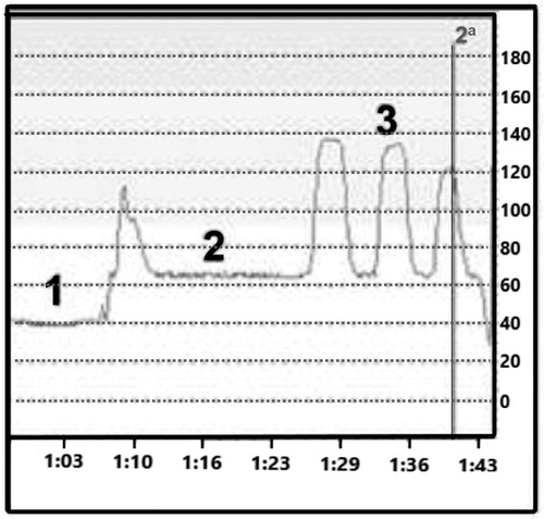 Figure 1. Representative manometric test. 1, rectal pressure; 2, resting pressure (in the anal canal); 3, maximum pressure (three voluntary contractions). The X axis shows time in minutes, while the Y axis shows pressure in mmHg.