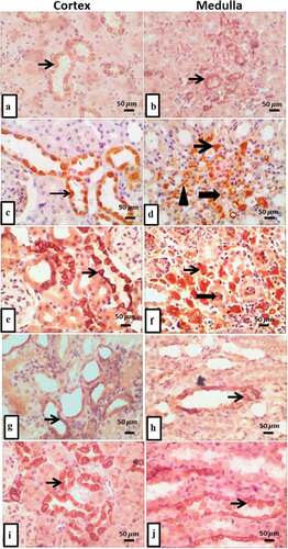 Figure 4. (a-j) Representative IHC expression of angiotensin II in renal cortical and medullary area of rat in different treated groups. a) control group demonstrates mild tubular Ang II expression (thin arrow), and b) shows mild expression in medullary tubule. c) T2DM group renal cortical regions shows intense positive immuno-stained Ang II in cytoplasm of tubular epithelium (thin arrow), and d) it shows intense Ang II expression in interstitial inflammatory cells (thin arrow), endothelial cells of interstitial capillaries (arrowhead) with moderate expression in intraluminal tubules and cytoplasm of medullary tubules (thick arrow). e) T2DM + thyroidectomy reveals strong tubular expression, and in f) it shows overexpression in medullary interstitium (thin arrow) and intraluminal (thick arrow). g) operative sham group shows moderate expression in medullary tubular and interstitium, and H) shows moderate cytoplasmic expression in cortical tubular epithelial cells (thin arrow). i) T2DM + thyroidectomy + L thyroxine demonstrates moderate cytoplasmic angiotensin expression, and J) shows moderate expression in medullary tubular and interstitium. Image magnification = 400×, scale bar = 50 µm.