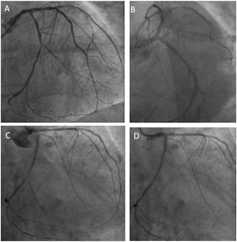 Figure 2. Panel A: coronary angiogram showing focal in-stent restenosis of LM, tight stenosis of ostial LCX, and a long lesion in distal LCX beyond the distal edge of the previous implanted stent. Panel B: angiographic image after multiple bare metal stent implantations on proximal and distal LCX, and in-stent re-PTCA of LM. Panel C: coronary angiogram showing severe and diffuse in-stent restenosis of LCX involving the ostium of OM branch; Panel D: angiographic image after re-PTCA of LCX.