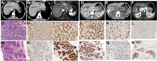 Figure 2 Images in a 34-year-old female (case 50) with non-VETC, non-MTT, CK19-positive HCC (lesion 1, S2 segment), VETC HCC, non-MTT, CK19-positive HCC (lesion 2, S6 segment) and baseline serum AFP level of 273 ng/mL. (A), lesion 1, 2.4 cm and (D), lesion 2, 4.5cm baseline HAP images (white arrow); (B and E): plain CT after the first session of cTACE, sparse and <50% (lesion 1), defect and >50% (lesion 2) lipiodol deposition (white arrow); (C and F): HAP Gd-EOB-DTPA MRI after the first session of cTACE: SD (lesion 1), PR (lesion 2) (alive lesion: red arrow); (G and M) HE of lesion 1 and 2, tumor cells were nest like and invasively grew; (H and N): non-VETC (lesion 1) and VETC (lesion 2) according to CD34 IHC; (I and O): lesion 1 and lesion 2 were both CK-19 strong positiveness; (J and P): lesions 1 and 2 were Glypican-3 positive; (K and Q): lesions 1 and 2 were Ki67 80% and 70% positiveness; (L and R): AFP negative (lesion 1) and positive (lesion 2) (×40 magnification).