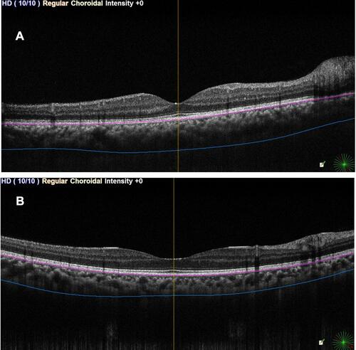 Figure 4 Enhanced depth imaging optical coherence tomography. Choroidal thickness is measured perpendicularly from outer limit of RPE to the posterior boundary of the choroid. (A) (above): Group A eye. (B) (below): Group B eye.