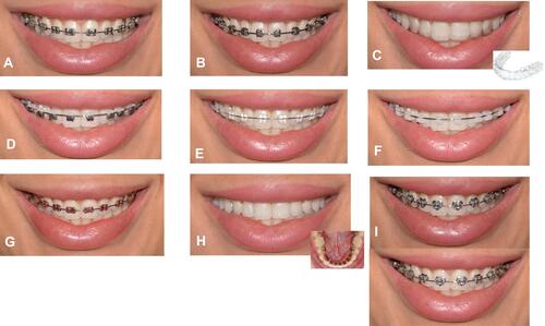 Figure 1 Orthodontic appliances evaluated by participants: (A) Metal brackets with transparent O-ties; (B) self-ligating metal brackets; (C) clear aligner; (D) hybrid brackets; (E) ceramic brackets with transparent O-ties; (F) self-ligating ceramic brackets; (G) metal brackets with colored O-ties; (H) bare teeth to simulate lingual brackets; and (I) shaped brackets (heart and superman logo).