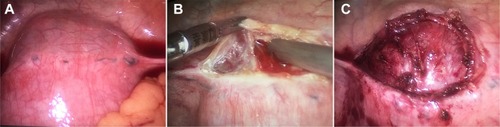 Figure 2 In laparoscopic approach, we detached bladder reflex of the uterus peritoneum.