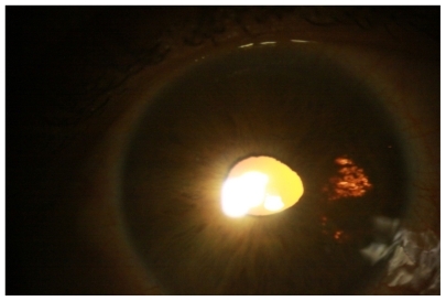 Figure 2 Transillumination defects of the left eye at 2 weeks.