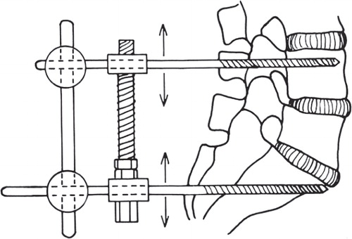 Figure 4. Temporary external transpedicular fixation trial: By externally fixing two vertebrae, one or more vertebral motion segments can be immobilised, thus simulating the effect of a spinal fusion.