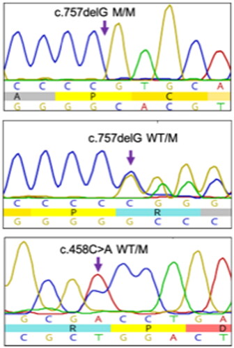 Figure 2. Representative electropherograms show that the c.757delG (p.Ala253Glnfs*27) variant is found in a homozygous and the c.757delG (p.Ala253Glnfs*27) and c.458C > A (p.Ala153Asp) in a compound heterozygous state in patients with CMT from our cohort.