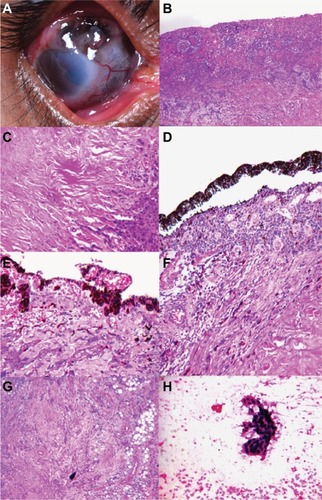 Figure 2 Clinicopathological correlation of noduloulcerative variant of ocular surface squamous neoplasia in human immunodeficiency virus-infected patients.