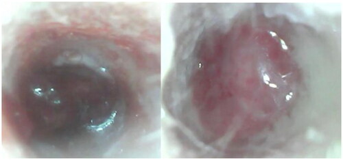 Figure 1. Polypoid tissue obliterating the external auditory canal of the right and left ear, respectively.