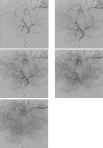 Figure 4 Digital subtraction angiogram of trans-femoral injection of contrast through the hepatic artery revealed a focal hepatic lesion with progressive increased arterial uptake (“tumoral blush”), confirming that the main origin of the HCC supply is from the hepatic artery not portal vein, like the rest of the hepatic parenchyma.