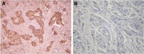 Figure 4 Immunohistochemical expression of CXCL12 and p-STAT3 in NSCLC tissues (SP method; magnification, ×200).