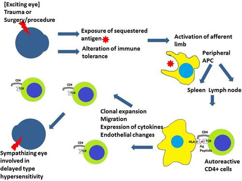 Figure 1 After the inciting event, the antigen-presenting cells (APC) present the antigen peptide to autoreactive CD4+ cells. This activates the CD4+ cells and brings about the autoimmune reaction damaging the other (sympathizing) eye.