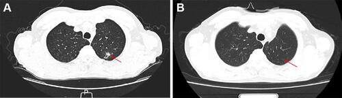 Figure 1 Chest computed tomography revealed the different stages of the patient’s lung tumor. (A) Initial diagnosis revealed a nodular high-density shadow in the posterior segment of the upper lobe tip of the left lung in April 2020. (B) CT scan after the surgery in June 2020.