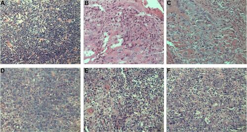 Figure S1 Nasopharyngeal carcinoma specimens by HE staining.Notes: Representative HE staining images for samples in (A) nasopharyngeal squamous cell carcinoma (high expression of HMGA2), (B) nasopharyngeal squamous cell carcinoma (high expression of E-cadherin), (C) nasopharyngeal squamous cell carcinoma (high expression of vimentin), (D) nasopharyngeal squamous cell carcinoma (low expression of HMGA2), (E) nasopharyngeal squamous cell carcinoma (low expression of E-cadherin), (F) nasopharyngeal squamous cell carcinoma (low expression of vimentin). All images, 400×.Abbreviations: HMGA2, high-mobility group protein 2; HE, hematoxylin and eosin.