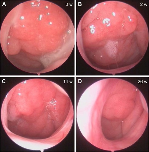 Figure 3 Representative nasal endoscopic follow-ups of a responder at 0 (A), 2 (B), 14 (C), and 26 weeks (D).