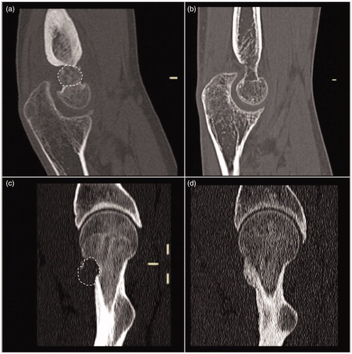 Figure 4. Sagittal reformatting of CT of the cases of the previous figures before (a) and (c) and 1 year after treatment (b) and (d). Note the complete disappearance and ossification of both the lesions with the restitutio ad integrum of the bone segments.