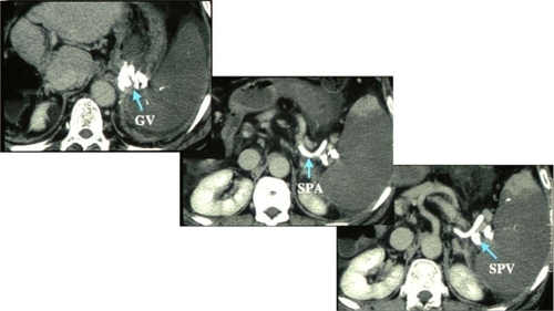 Figure 2c Five days after obliterative therapy, CT images demonstrate large infarctions encompassing 90% of the spleen.