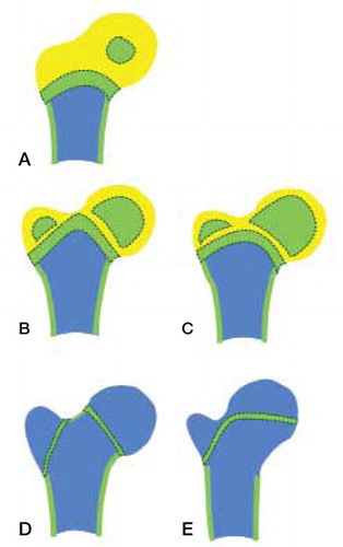 Figure 3. Schematic representation of the growing human hip region, showing the primary femoral and secondary capital and greater trochanteric ossification centers and proximal diaphyseal growth plate at ages of 1 year (A), 2–4 years (B, C), and > 4 years (D, E). Panels A, B, and D represent normal development, showing isthmic interruption of the chondroepiphysis prior to trochanteric osseous expansion, normal orientation of the capital growth plate, and normal head-neck offset. Panels C and E represent persistence of the isthmic part of the chondroepiphysis with subsequent coalescence of expanding secondary ossification centers, horizontal orientation of the capital growth plate, and reduced head-neck offset.