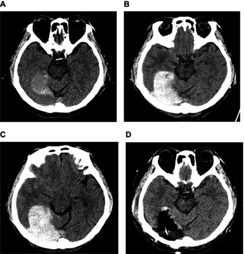Figure 1 Serial CT brain imaging in follow-up, showing gradual enlargement of right tentorial SDH. (A) initial view of scanty right tentorial SDH, (B, C) status of SDH 16 and 26 hrs later, respectively, enlarging and propagating to right convexity, and (D) post-operative view.