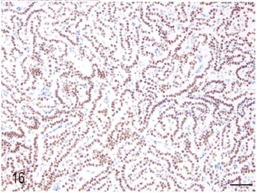 Figure 16. Case 3. The pulmonary adenoma was diffusely positive for TTF-1 immunohistochemistry. Bar = 50 µm.