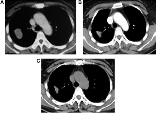 Figure 1 The computed tomography scan at diagnosis with a 3.9 cm bean-shaped tumor in the upper lobe of right lung (A). The lesion had significant reduction in tumor size 1 month later (B), and remained stable for 31 months with oral icotinib therapy (C).